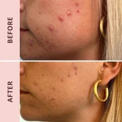 Pudderdåserne Azelainsyre 10%, 50 Ml 6 Pudderdåserne Azelainsyre 10%, 50 Ml -Murad Shop 5711914189136 2