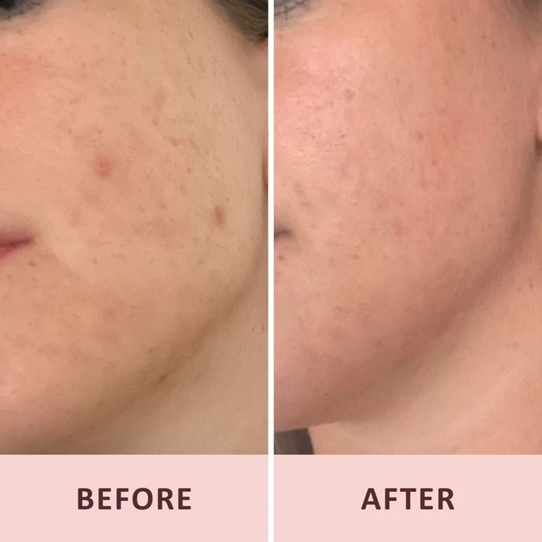 Pudderdåserne Azelainsyre 10%, 50 Ml 4 Pudderdåserne Azelainsyre 10%, 50 Ml - Billede 4